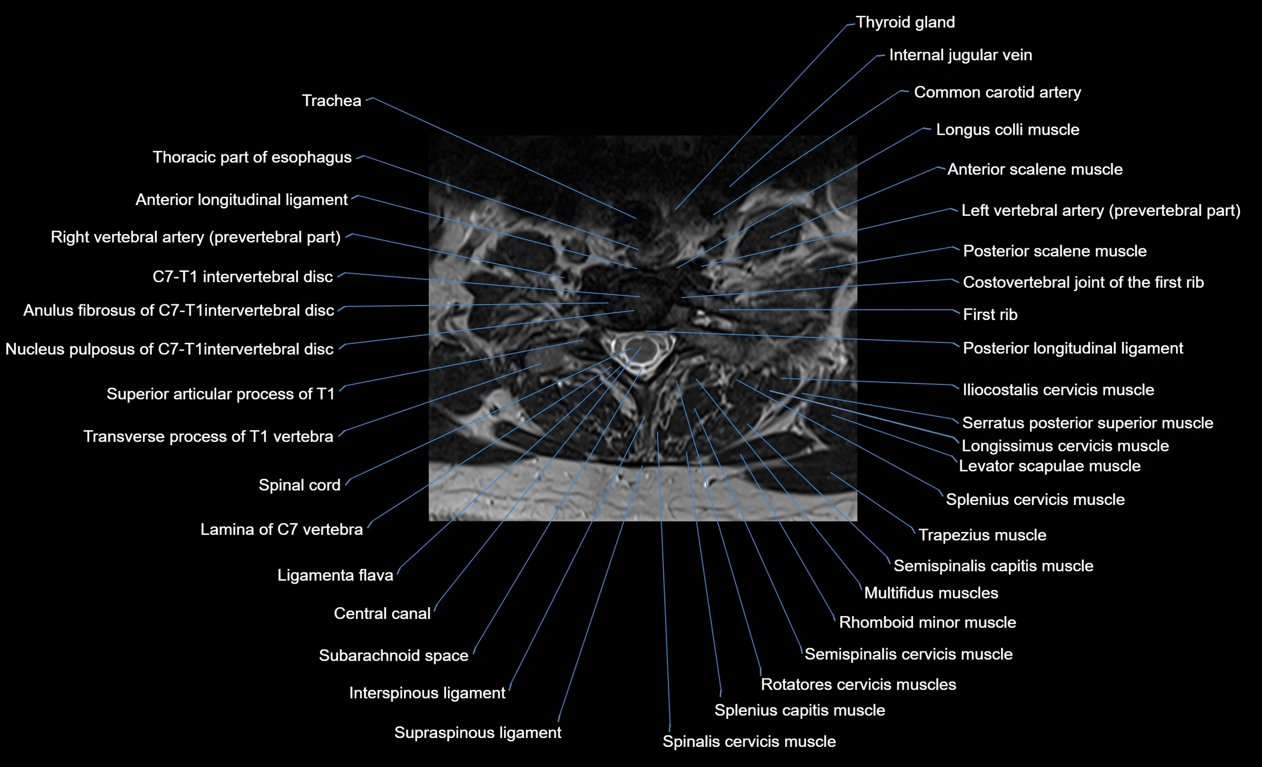 cervical spine cross sectional MRI anatomy  3T MRI axial  image-img-00001-00039.webp